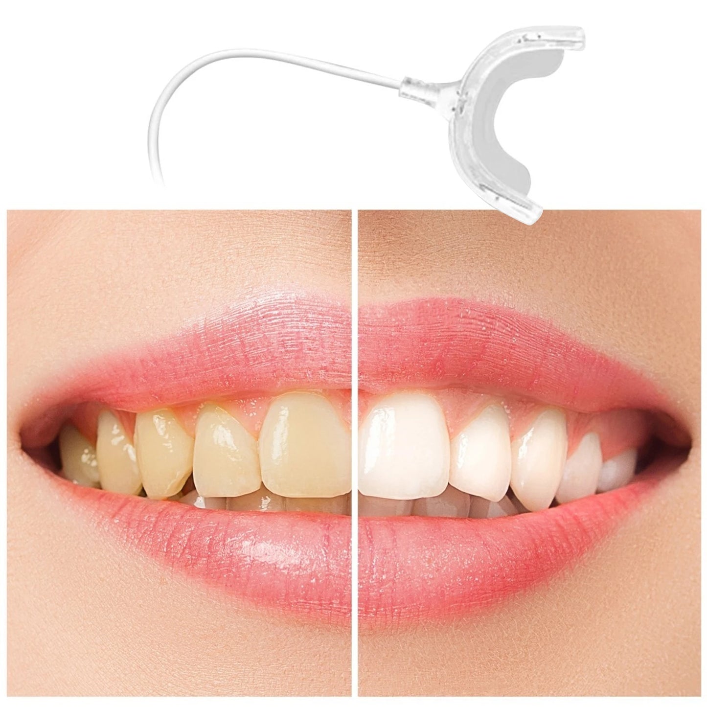 Smart LED Teeth Whitening Device - Portable USB Charging